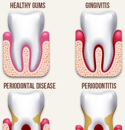 Hidden Dangers of Gum Disease