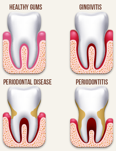 Hidden Dangers of Gum Disease