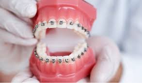 Orthodontic Treatment for Children