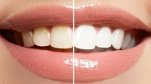 Teeth Whitening Treatment in Kothrud