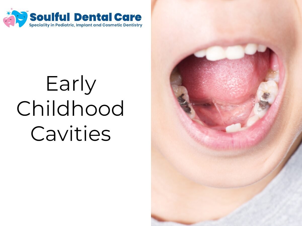 Early Childhood Cavities: Prevention, Detection, and Treatment