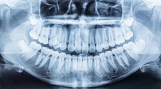 wisdom teeth