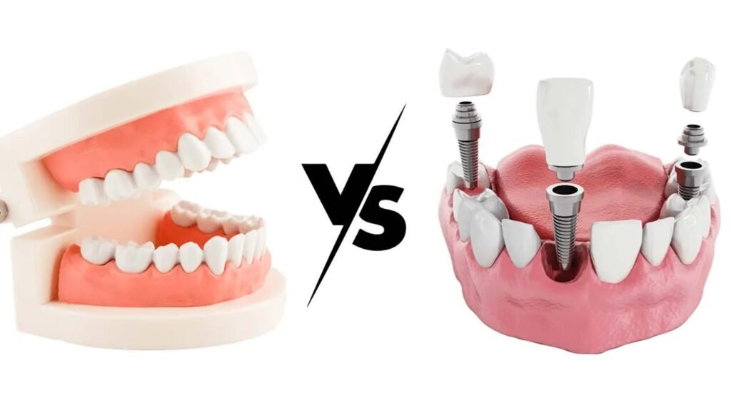 Dental Implants vs. Dentures: Which Is Better?