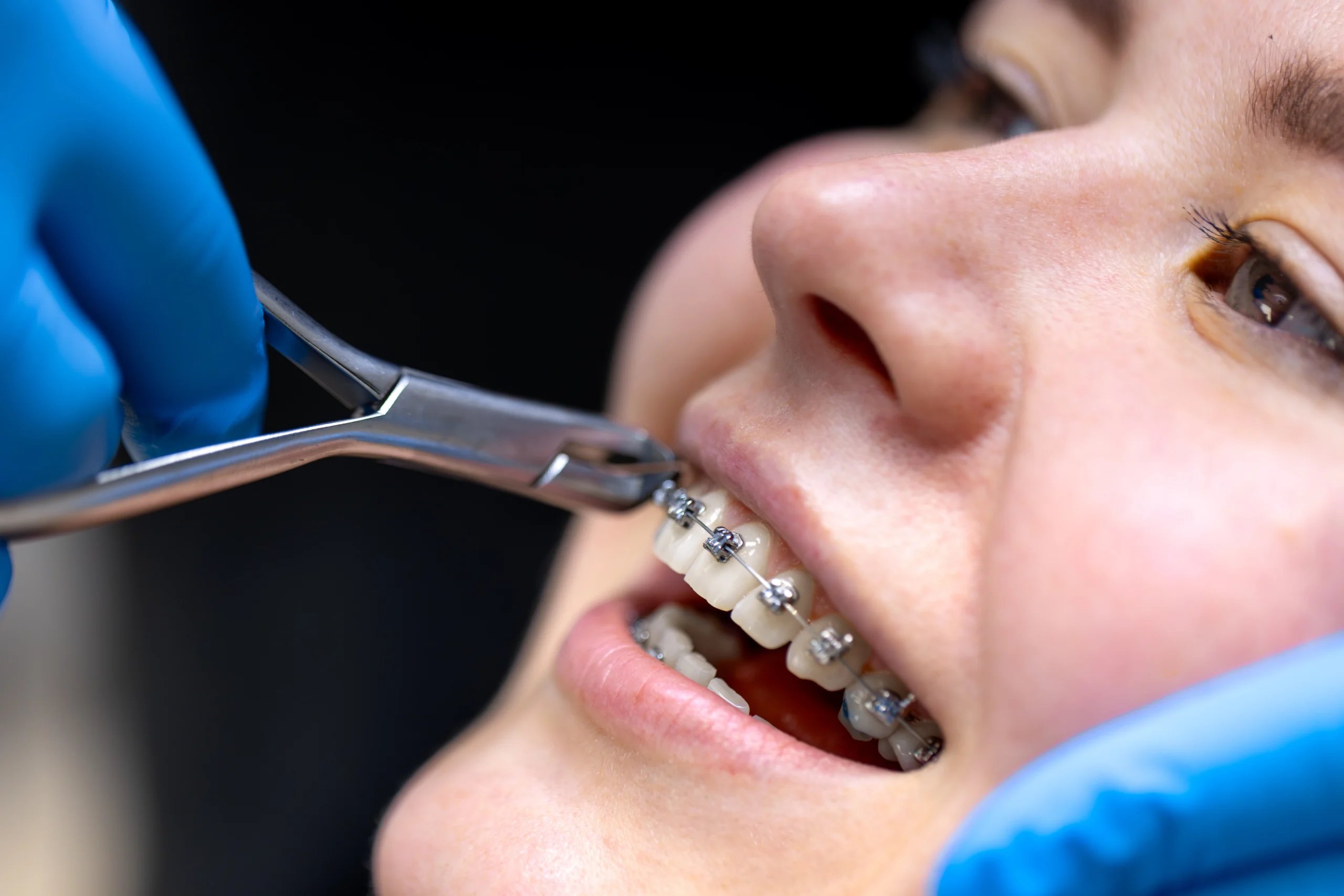 Get Myofunctional Orthodontics in Kothrud Pune
