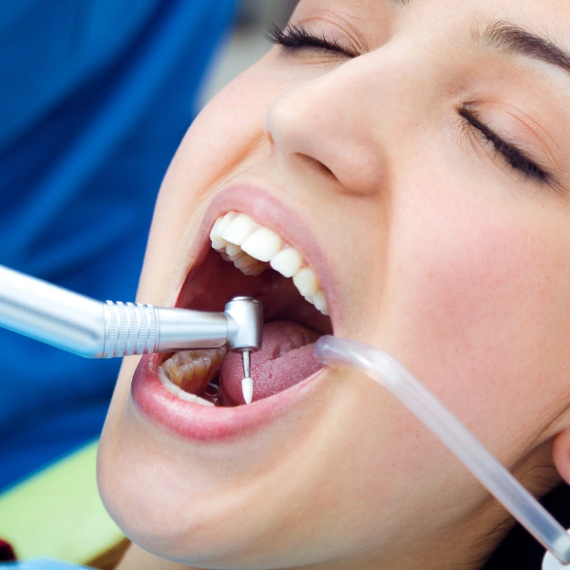 Find Dental Filling Treatment in Kothrud