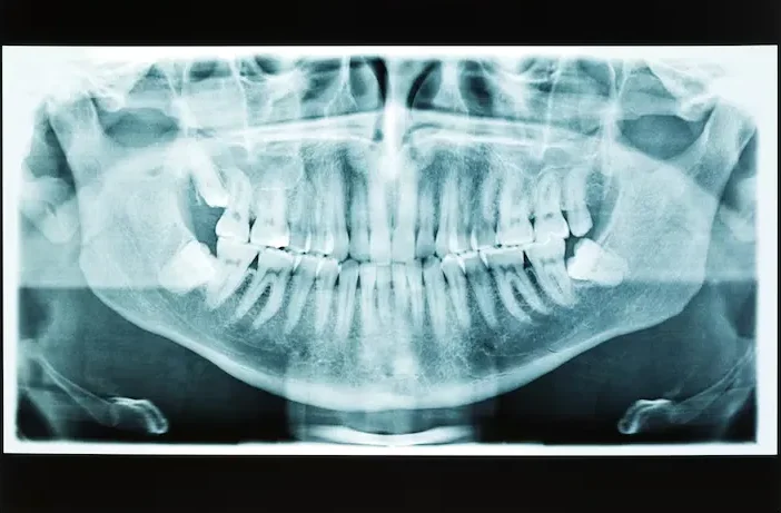 Oral Health Consultation X-Ray in Kothrud Pune | Soulful Dental Care