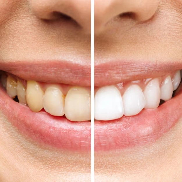 Teeth Whitening Treatment in Kothrud